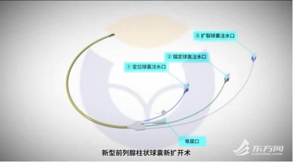 尿频水都不敢喝?专家:中老年男性常见,微创手术可治